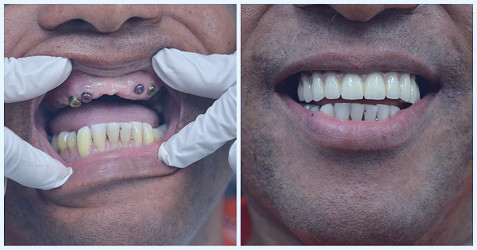 Full Mouth Reconstruction NYC | Information & Pricing